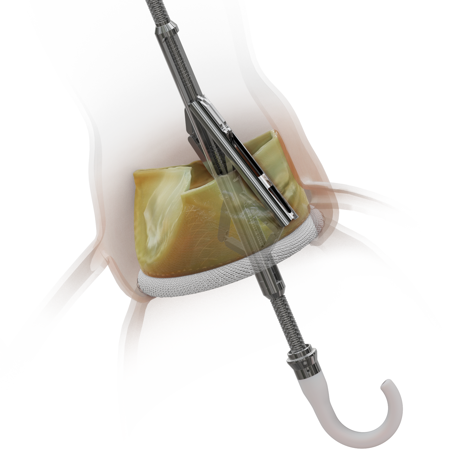 Pi-Cardia's ShortCut Leaflet Modification Device for TAVR Used in